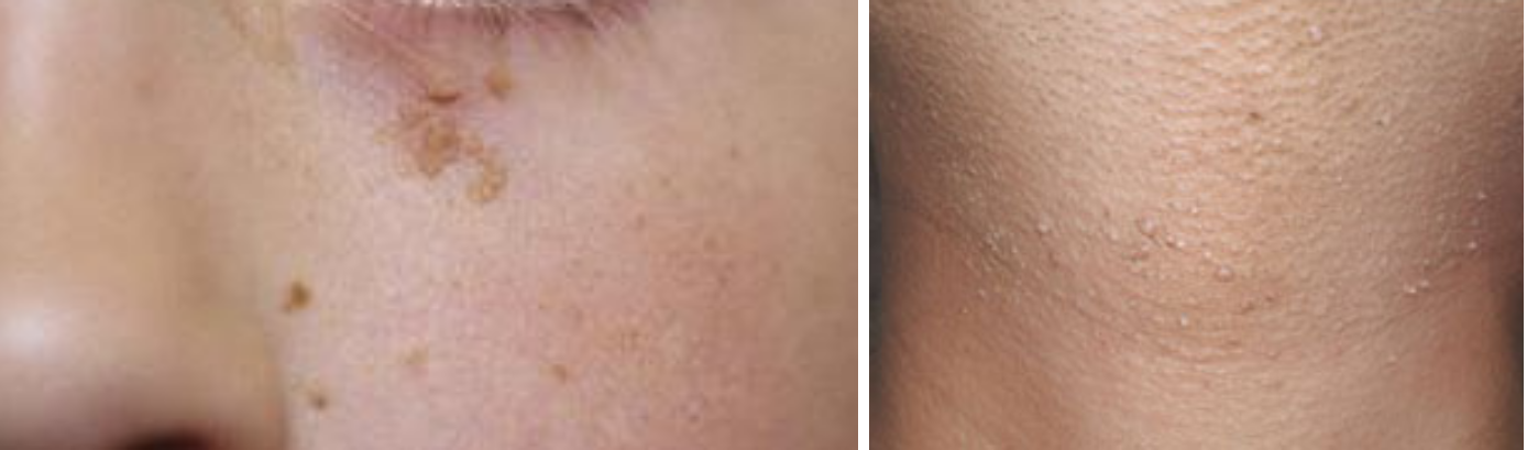 Abdomen Liposuction Image